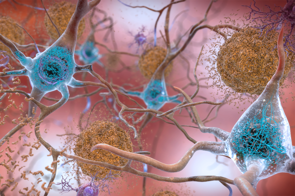Reassessment of Alzheimer's Drug Raises Hope--and Concerns