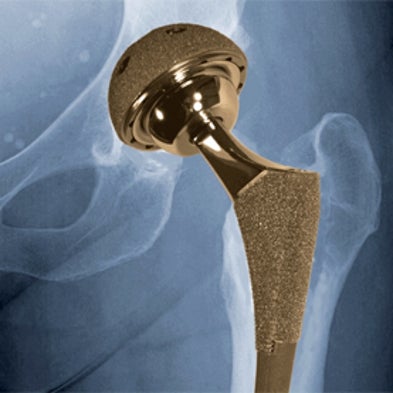 4 Medical Implants That Escaped FDA Scrutiny - Scientific American