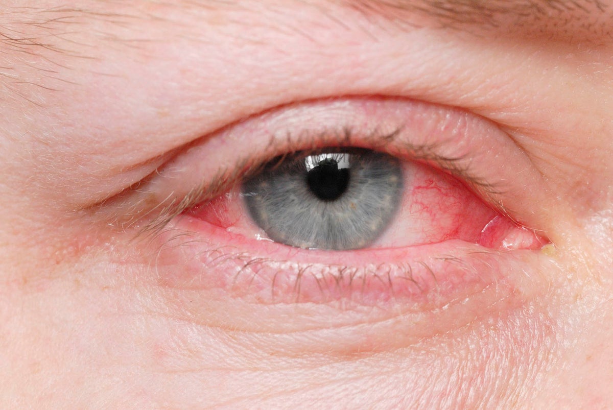 7 Pink Eye Symptoms You Shouldn't Ignore