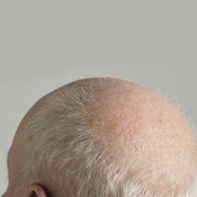 Treating Baldness is 