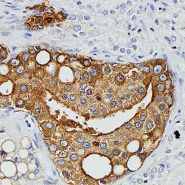 Retrovirus Linked to Aggressive Prostate Cancer
