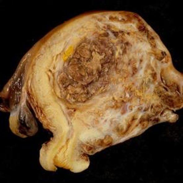 Biopsies Found to Provide Only a Snapshot of Tumor Diversity