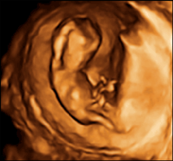 New Source of Stem Cells: Amniotic Fluid