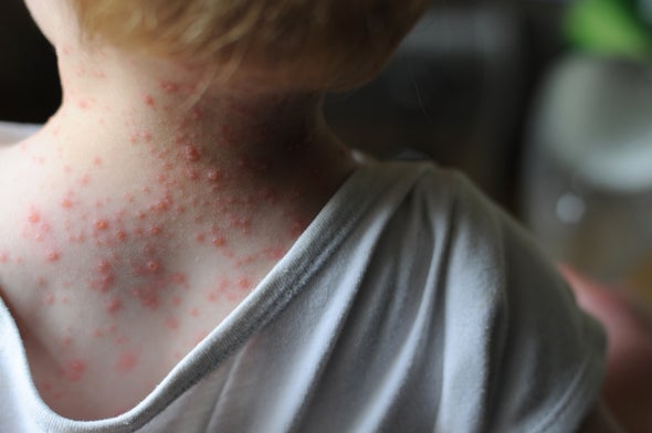 Two-for-One: Chickenpox Vaccine Lowers Shingles Risk in Children