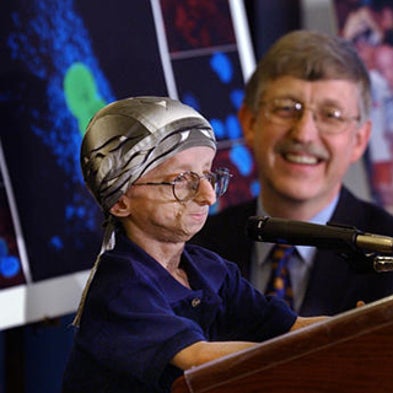 New Hope for Progeria: Drug for Rare Aging Disease