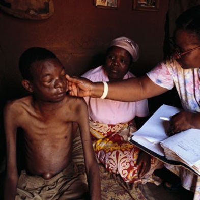 Tuberculosis conspires with HIV to make the disease worse