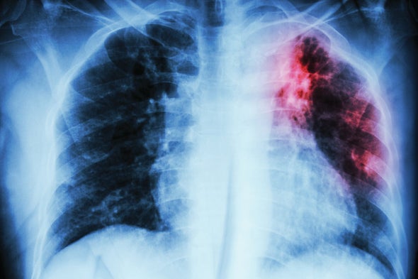 Scientists Solve a Deadly TB Mystery