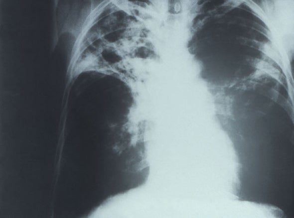 Tuberculosis Now Rivals AIDS As Leading Cause of Death, Says WHO