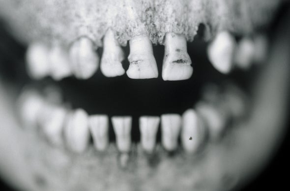 Ancient Tooth Tartar Traps Clues to Iron Age Diet