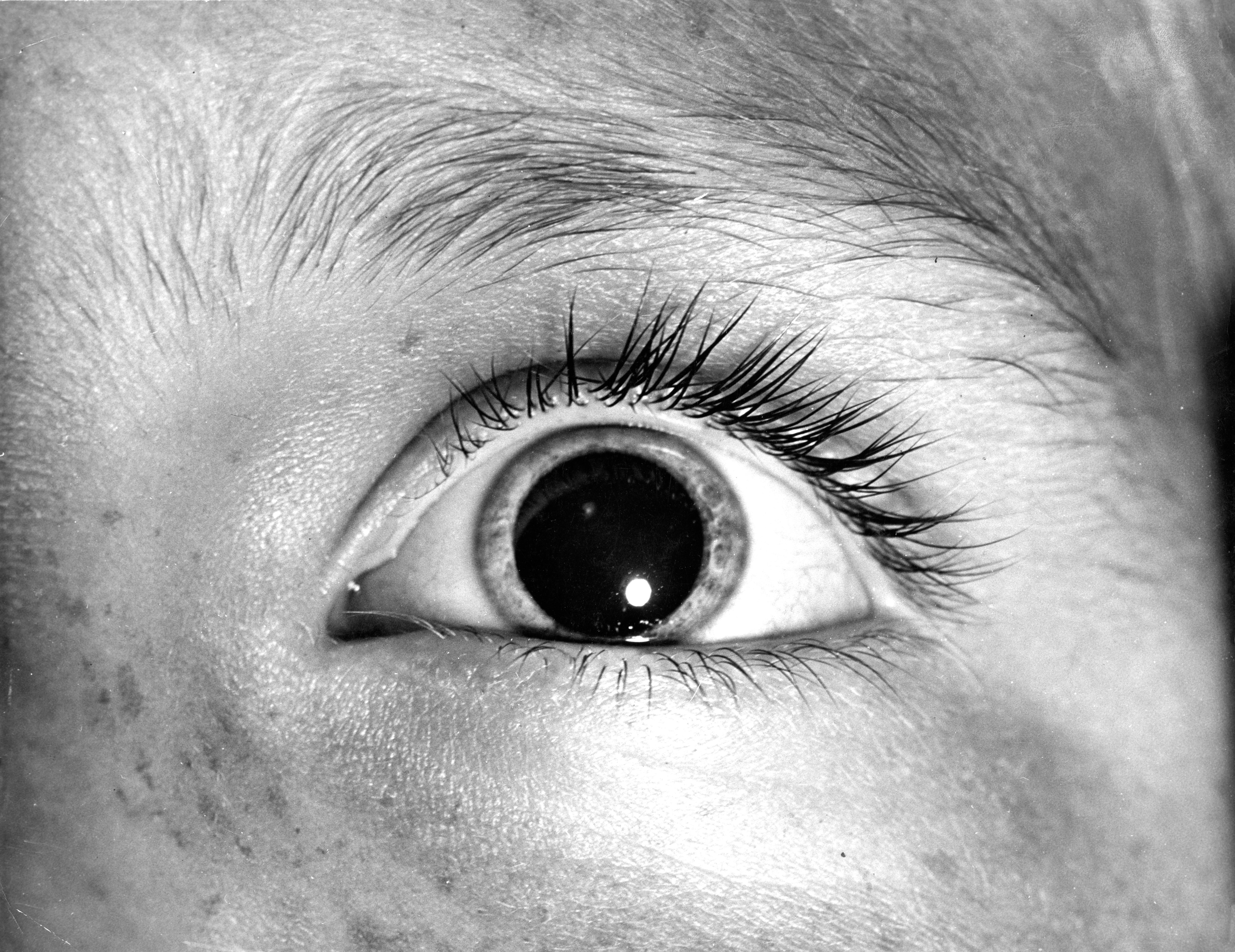 Pupils Dilate In Light - Extreme Pupil Dilation From Light.