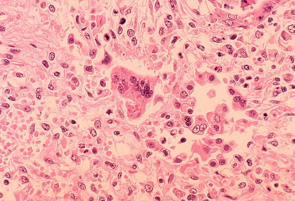Spreading Measles Outbreak Also Takes Heavy Economic Toll