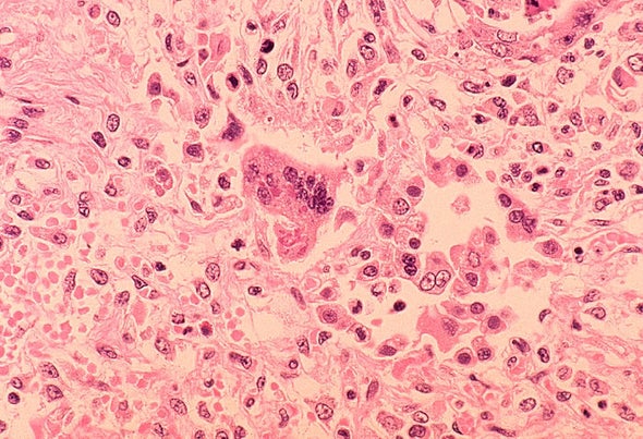 Spreading Measles Outbreak Also Takes Heavy Economic Toll