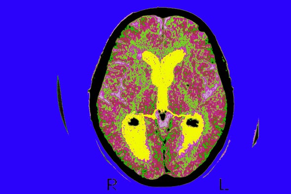 Here's What We Think Alzheimer's Does to the Brain