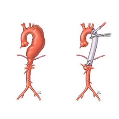 Sudden Death: What Is Marfan’s Syndrome?