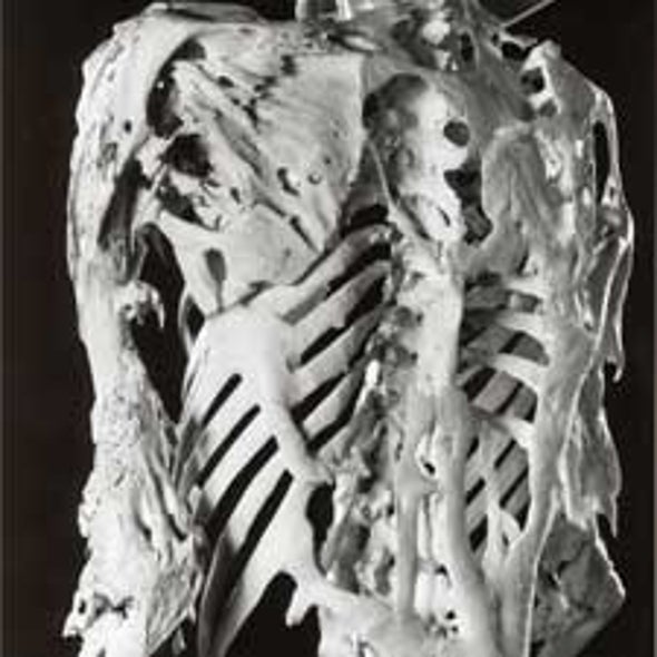 How Can a Genetic Mutation Cause Muscle to Turn into Bone?