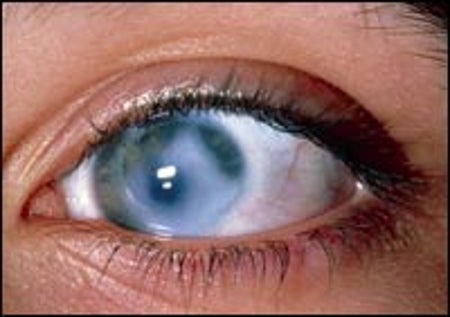 GLAUCOMA,