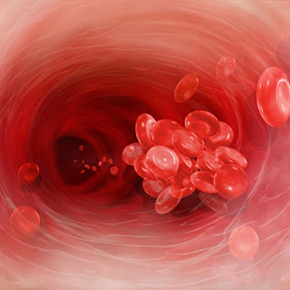 what is deep vein thrombosis dvt scientific american