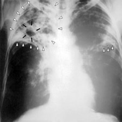TB or Not TB?: Novel Detector Could Shorten Testing Times, Aid Treatment Efforts