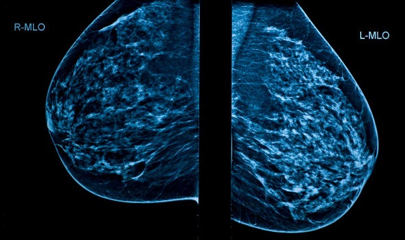 U.S. Panel Finalizes Breast Cancer Screening Recommendations