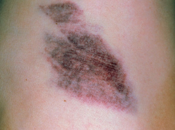 When to Worry about a Bruise