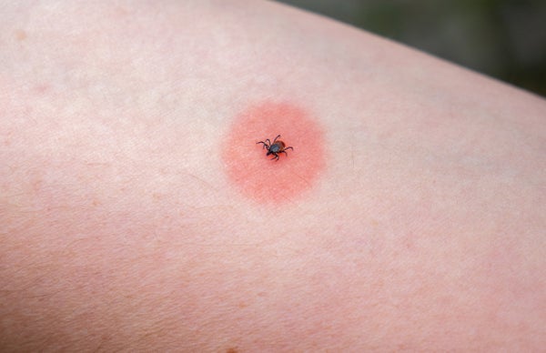Red spot from tick bite on arm