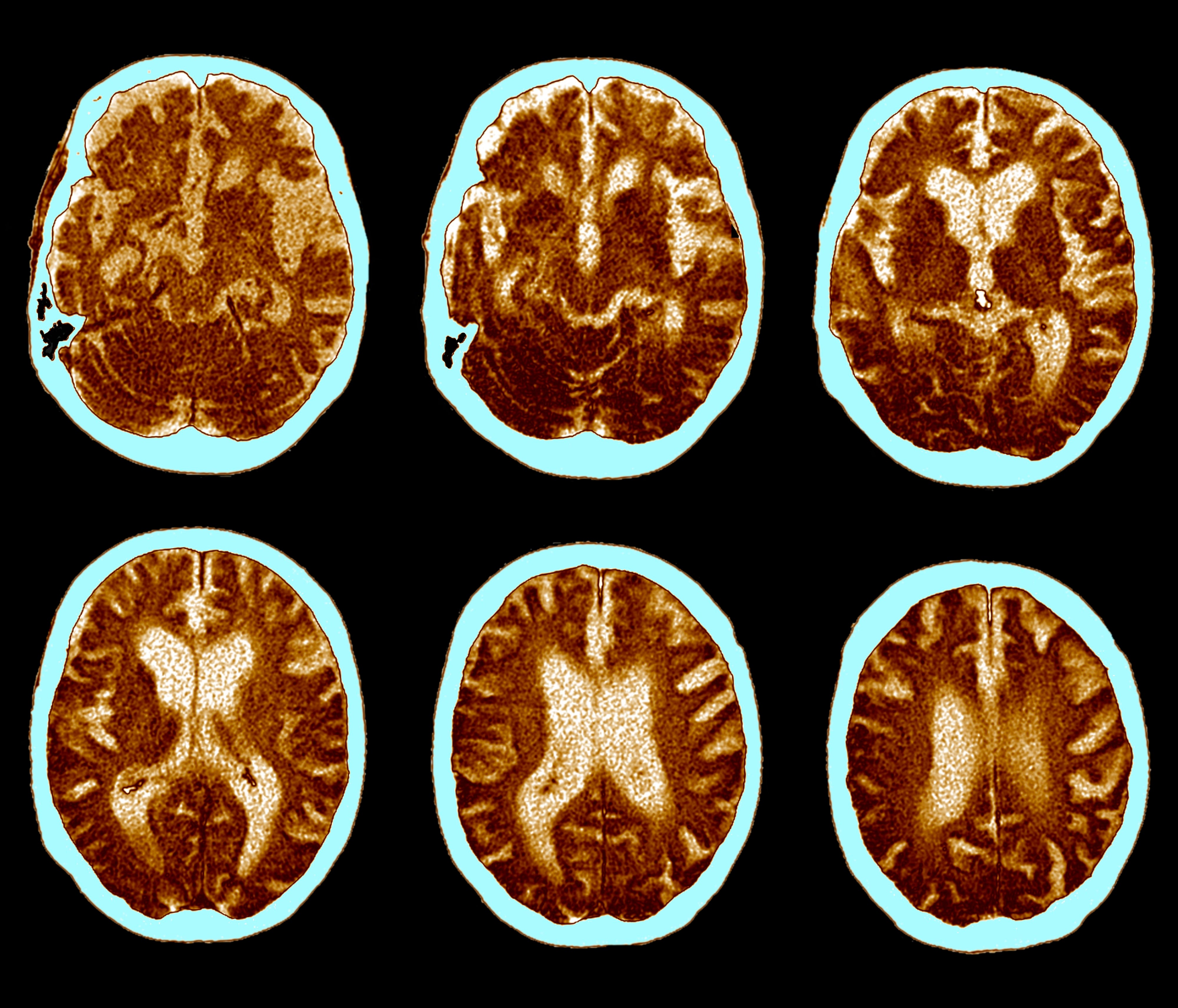 aspergers syndrome brain compared to normal brain