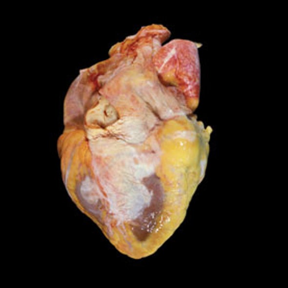Telltale Hearts: What Autopsies Reveal about This Vital Organ