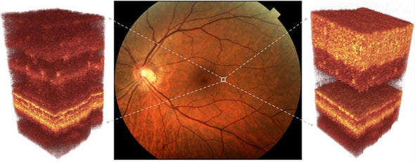 Sightseeing: Adaptive optics could peer deep into damaged eyes for earlier diagnoses