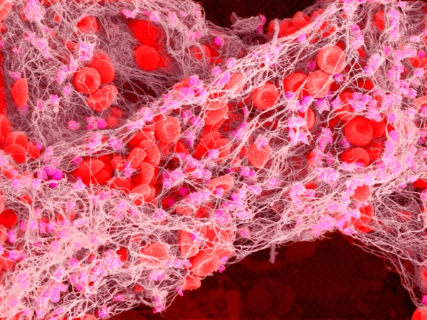 Scanning electron micrograph of a blood clot in human blood, magnification x2000