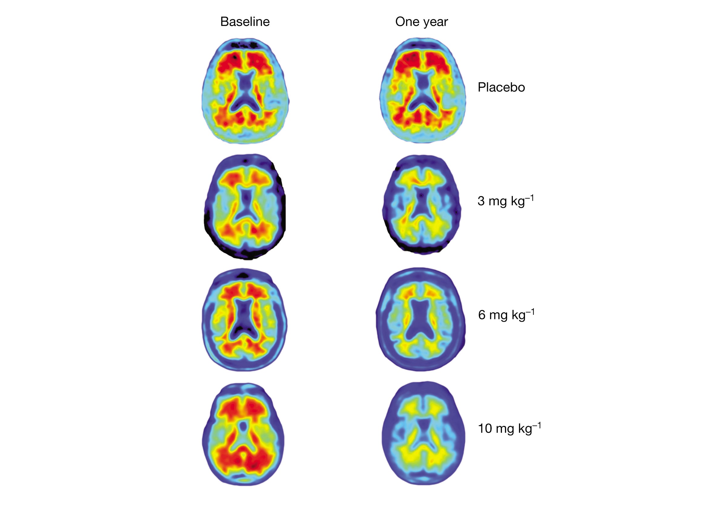 Watch New Alzheimer’s Drug Shows Promise in Trial video Watch New Alzheimer’s Drug Shows Promise in Trial video