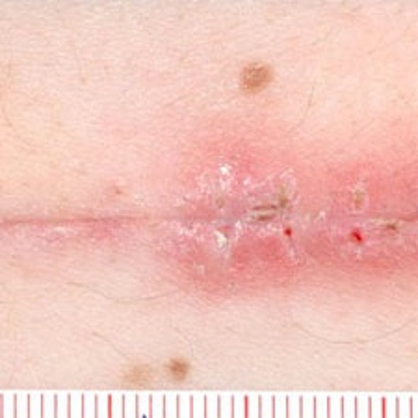 Lasers Demonstrate the Power to Heal Without Scarring