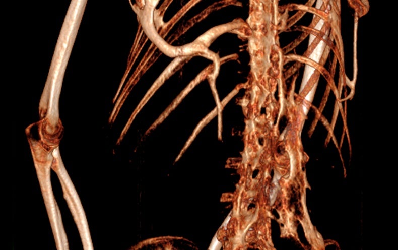 ultra-rare-bone-forming-disease-reveals-its-secrets-scientific-american