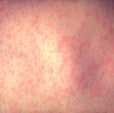 Measles Outbreaks Follow a Predictable Path&mdash;Provided People Get Vaccinated
