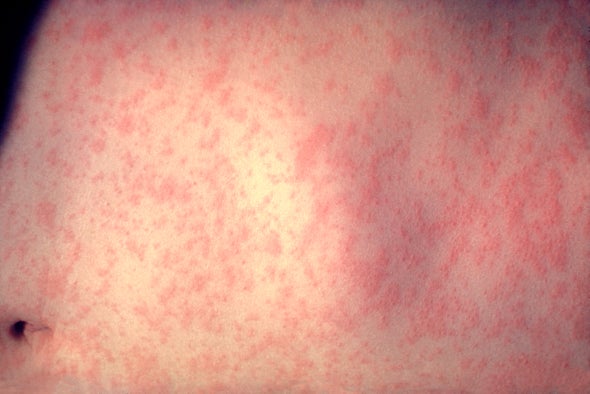 Measles Outbreaks Follow a Predictable Path&mdash;Provided People Get Vaccinated