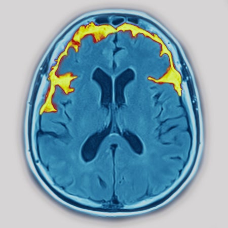 半裸脑通过MRI视觉化