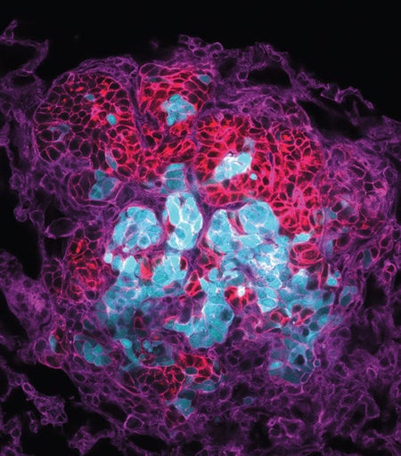 cancer cells