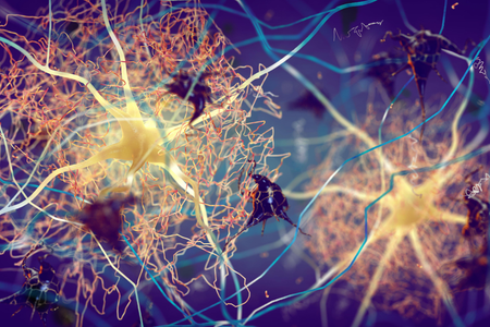 Artist's rendering of Beta-amyloid protein disrupting nerve cells function in a brain with Alzheimer's disease