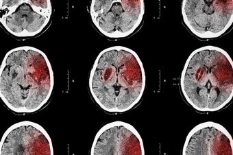 New Method for Tackling Stroke Restrains an Overactive Immune System
