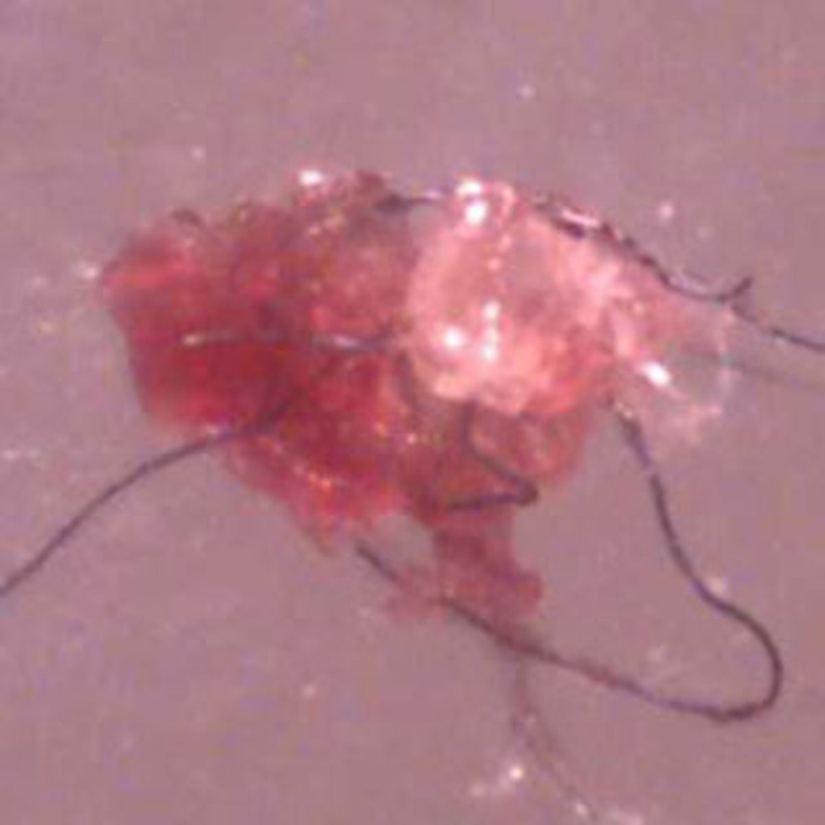 What is Morgellons Disease? Is it a physical or psychological