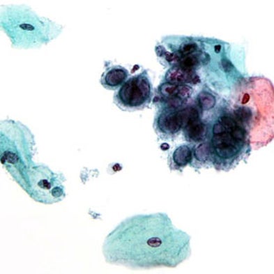 Small Comfort: Nanomedicine Able to Penetrate Bodily Defenses