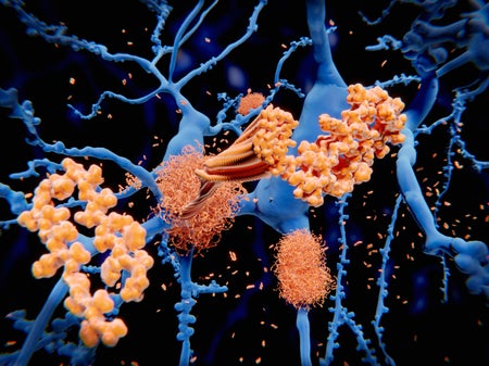 llustration of the processes leading to the formation of amyloid plaques (tangled bundles) on neurons (nerve cells, blue).