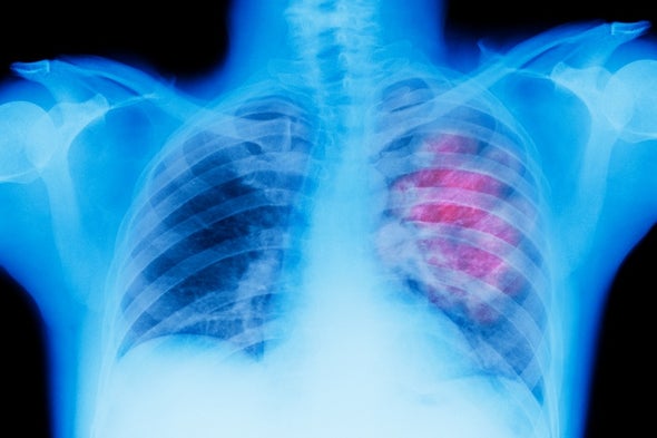 Lung Cancer Screen Could Be Easy-pee-sy
