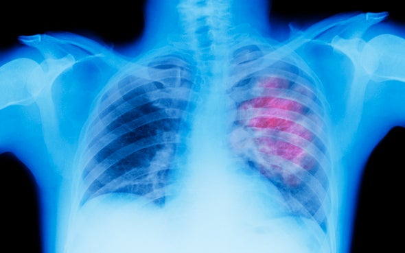 Lung Cancer Screen Could Be Easy Pee-sy