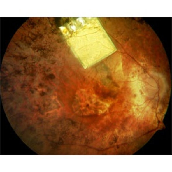 Electric Eye: Retina Implant Research Expands in Europe, Seeks FDA Approval in U.S.