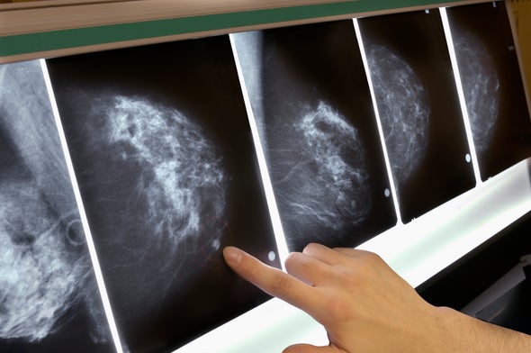 Hormone Therapy during Menopause Raises Breast Cancer Risk for Years