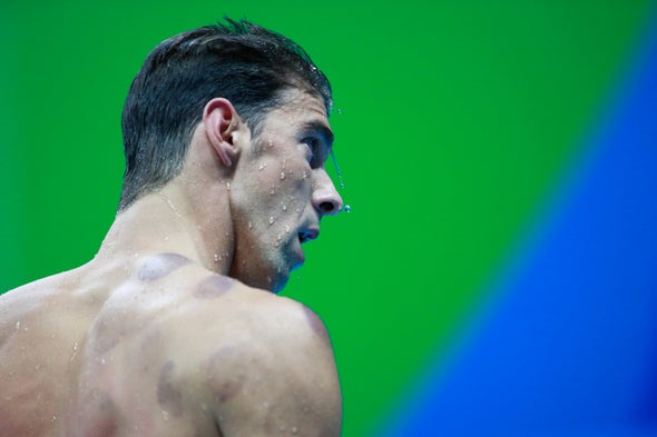 Can "Cupping" Treatments Raise Anything but Welts for Phelps or Other Olympians?