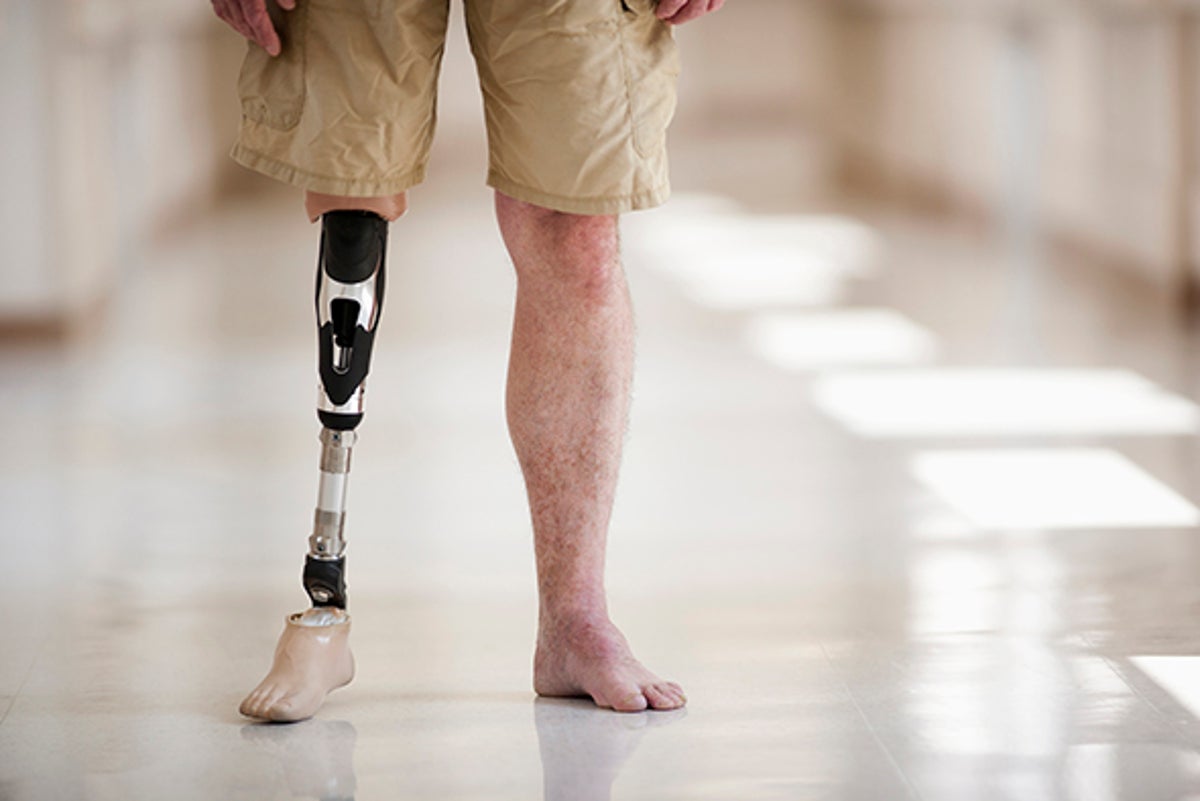 Next-gen Device Could Relieve Phantom Limb Pain