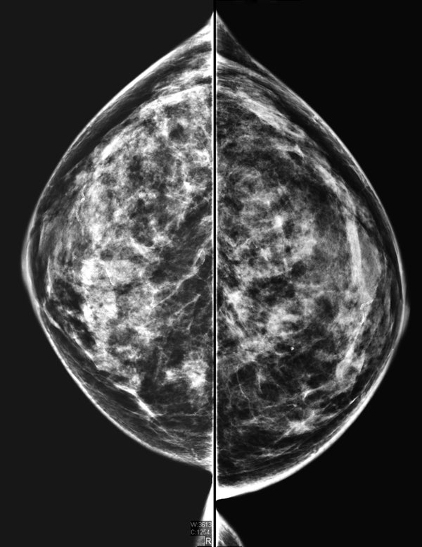 Digital mammogram of dense tissue