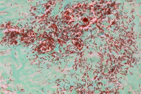 Light micrograph (LM) of a section of bacterial invasion of human gut wall.