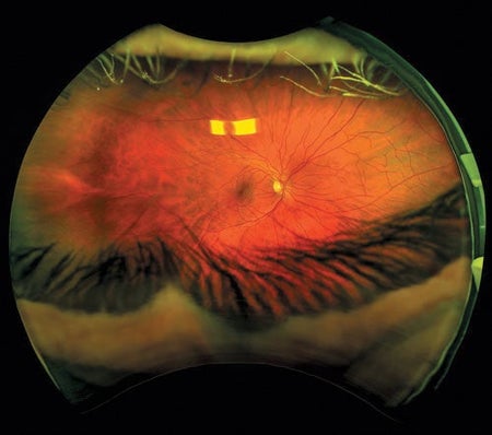 A circular view of a retinal scan, with eyelashes shown at the top and bottom of the frame, against a black background.